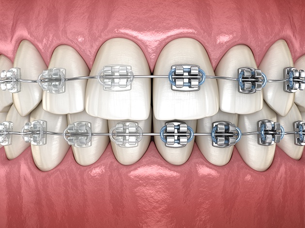 A picture of clear braces