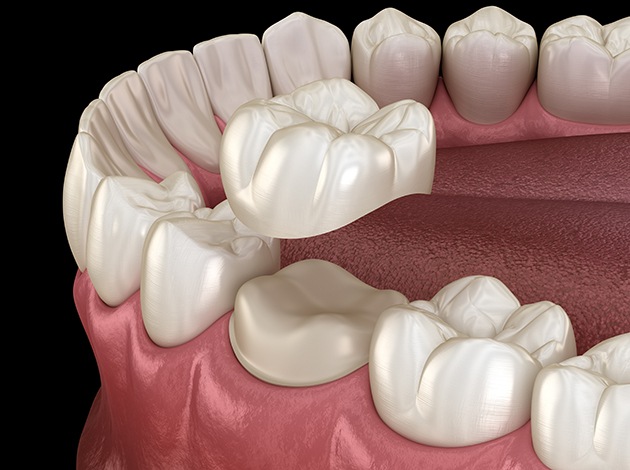 Illustration of crown being placed on prepared tooth