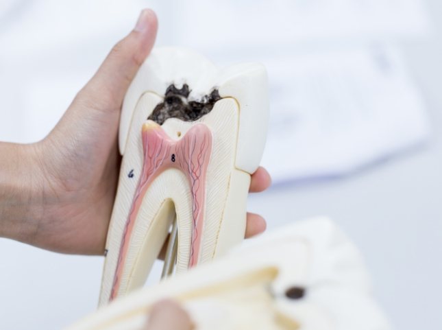 Hand holding a model of a decayed tooth