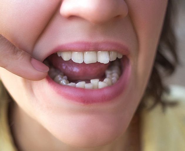 Girl with crooked teeth